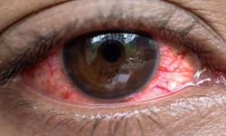 Uganda'da salgın: 7 bin 500 kişide "kırmızı göz" hastalığı görüldü