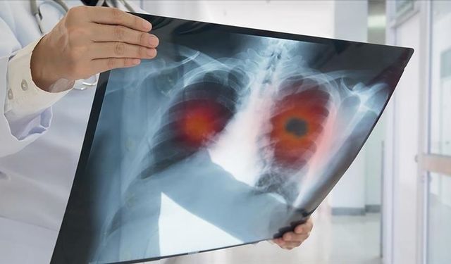 Ülkemizde yılda ortalama 41 bin kişi akciğer kanserine yakalanıyor