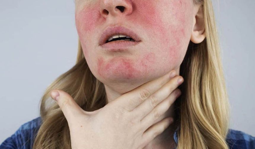Uzmanı uyarıyor! Soğuk alerjisi deyip ihmal etmeyin