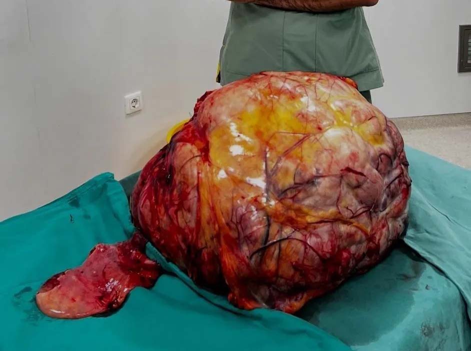 Kadin Tumor 26 Kilo Trabzon